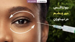 بوتاکس دور چشم در نیاوران