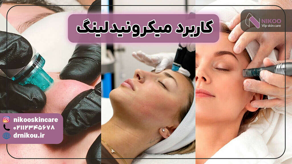 کاربرد میکرونیدلینگ
