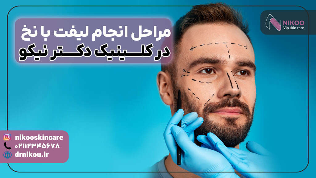 مراحل انجام لیفت با نخ 