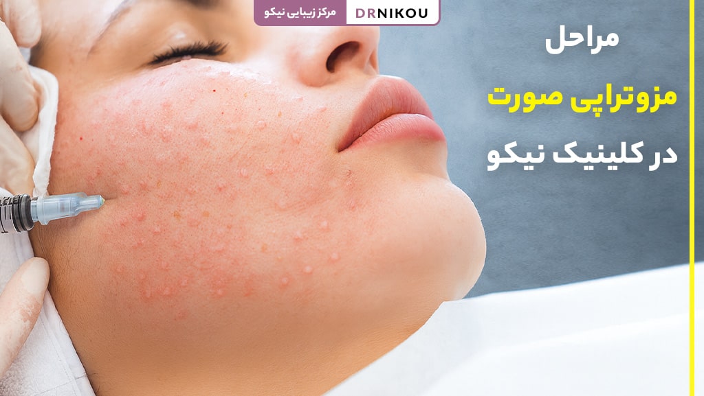 مراحل مزوتراپی 