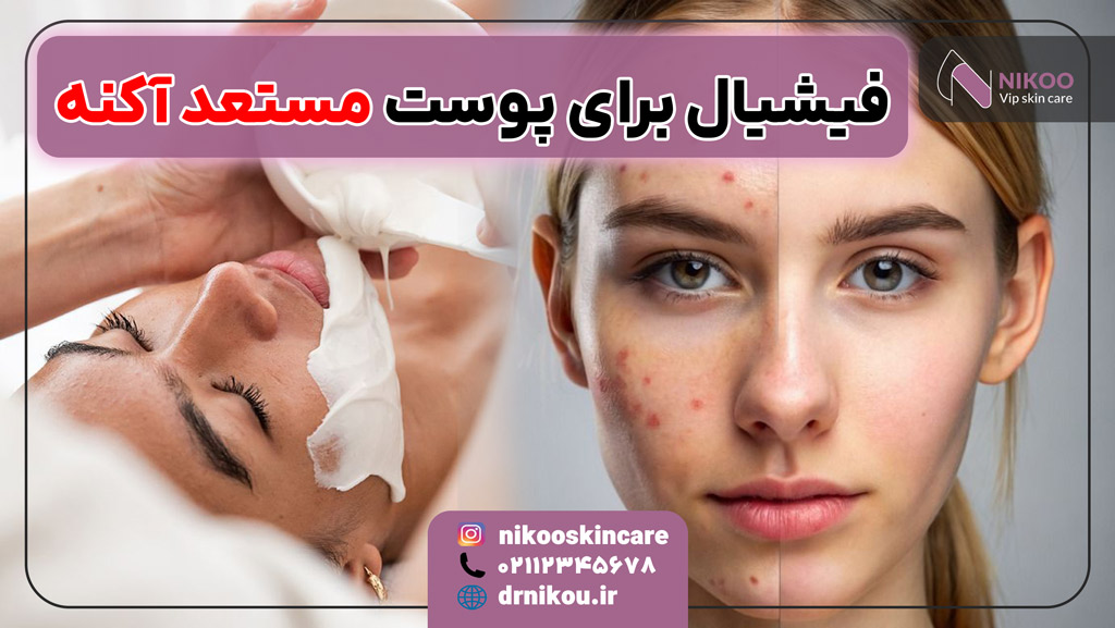فیشیال برای پوست مستعد آکنه