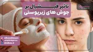 فیشیال برای جوش های زیر پوستی